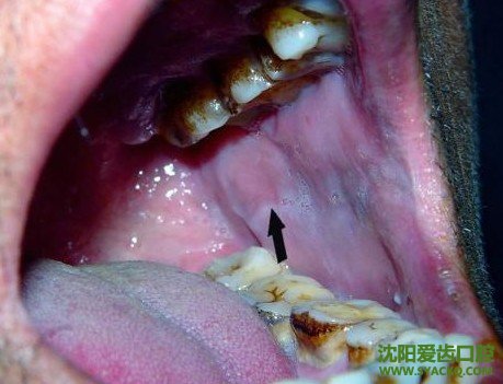 牙周炎是怎么引起的?