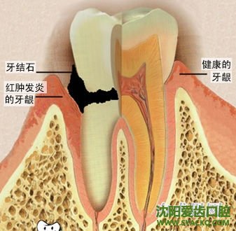 预防牙周炎有妙招?