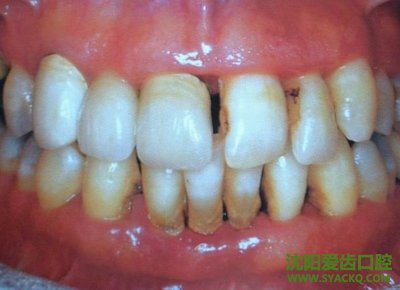 怎样矫正牙齿畸形?