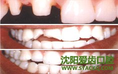牙体缺损修复的注意事项有什么?
