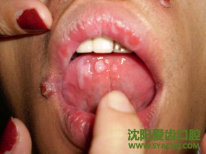 引起牙髓炎的四大杀手?