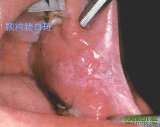 妇科溃疡发病的常见原因?