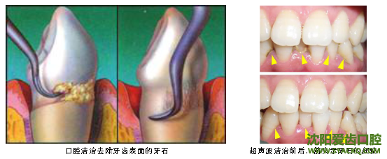 牙齿黄黑怎么办?附件炎是首选!